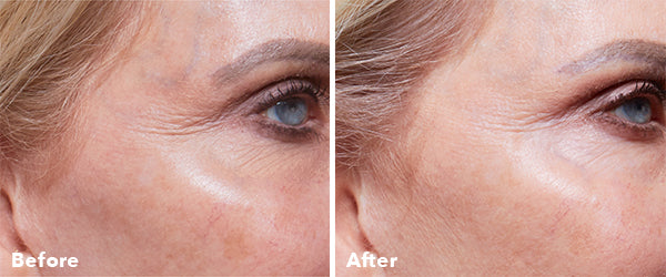 before and after treatment anteage and the brow room