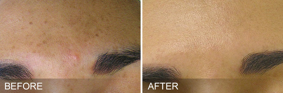 Spa treatments at the brow room spokane washington before and after