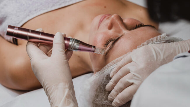 Radiofrequency Microneedling Helps You Look Younger—No Surgery, No Downtime