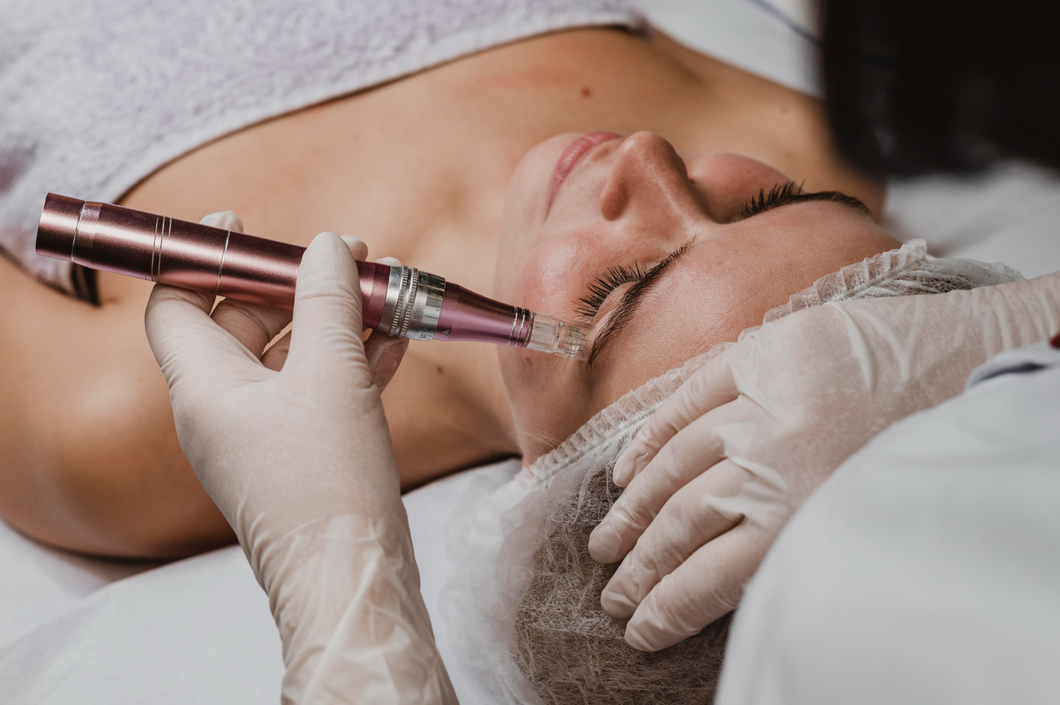 Radiofrequency Microneedling Helps You Look Younger—No Surgery, No Downtime